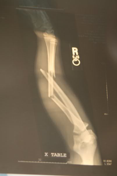 brokenarm.jpg